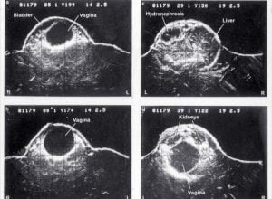 Haematocolpos age 5 weeks (1977)