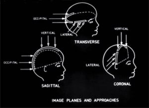 Scan planes commonly used in babies' heads