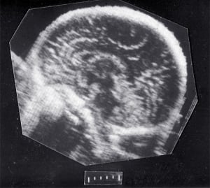 Normal mid-sagittal anatomy