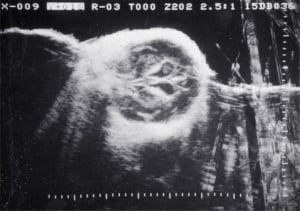 Twin II with intraventricular haemorrhage (1980)