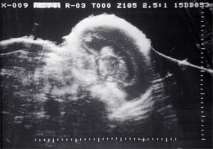 Twin II with intraventricular haemorrhage (1980)