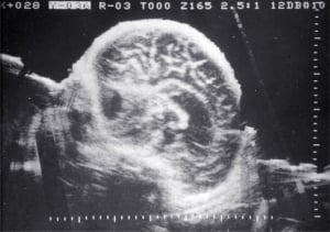 Posterior fossa cyst (1980)