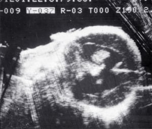 Choroid plexus papilloma (1979)