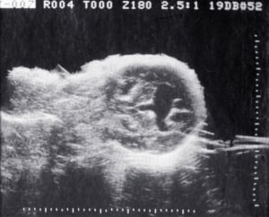 Lobar holoprosencephaly (1980)