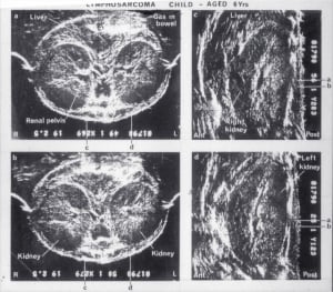 Lymphosarcoma in 6-year-old child (1978)