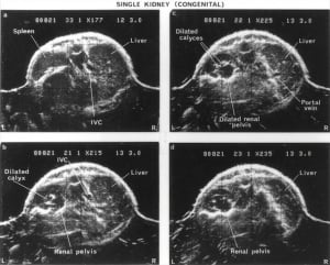 Abdomen of child with solitary kidney