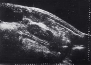 Medial ectopia of the right kidney in a child