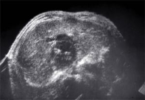 Ganglioneuroma in paraaortic chain, 12-year-old child