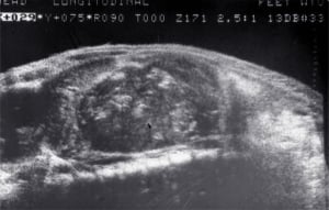 Ganglioneuroma in paraaortic chain, 12-year-old child
