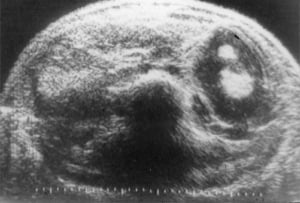 Angiomyolipoma in 4-year-old child