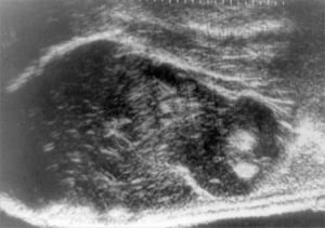 Angiomyolipoma in 4-year-old child