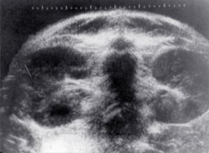 14-year-old child with lymphoma in both kidneys