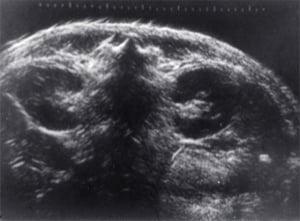 14-year-old child with lymphoma in both kidneys post radiotherapy