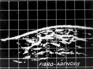 Early breast scan (1966)