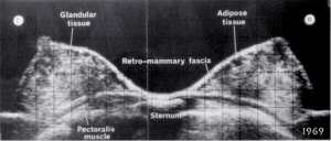 Composite image in 38 year old woman (1969)