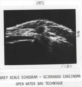 Scirrhous carcinoma (1971)