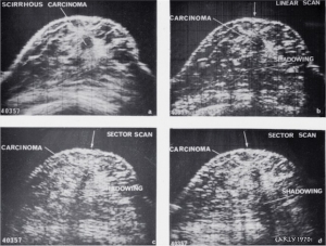 Scirrhous carcinoma - comparison of (a) compound, (b) linear, (c) and (d) sector scans (1972)