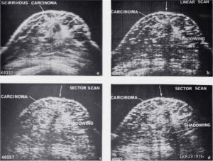 Scirrhous carcinoma - comparison of (a) compound, (b) linear, (c) and (d) sector scans (1972)