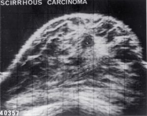 8 mm carcinoma with low level echo content (1972)