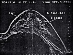 Normal breast (1977)