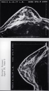 Normal breast (1977)