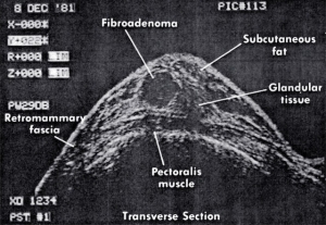 Fibroadenoma (1981)