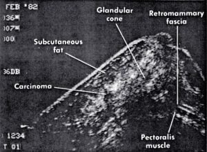 Scans - Breast (1982)
