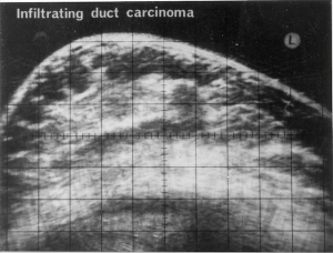 Infiltrating duct carcinoma