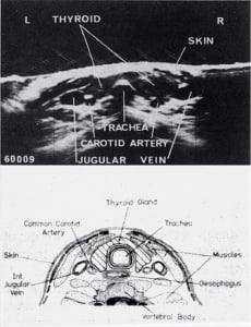 Thyroid image and schematic drawing