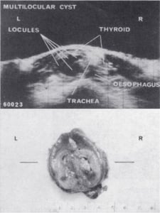 Multilocular cyst and surgical specimen