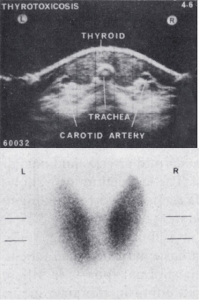Thyrotoxicosis and technetium scan