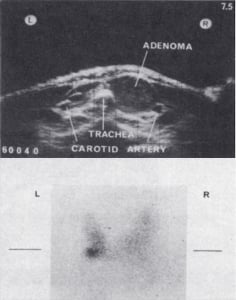 Adenoma and technetium scan