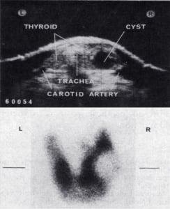 2 cm diameter cyst and technetium scan