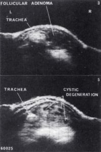 5 cm diameter degenerating follicular adenoma