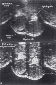 Compound and simple scan of normal testes