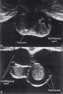Top: 8 mm epidydimal cyst Bottom: extensive hydrocele and large epidydimal cyst
