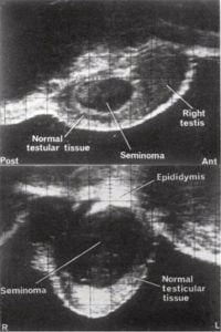 Top: 3 x 1.5 cm seminoma Bottom: 4 x 3.5 cm seminoma