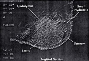 Scrotum (1981)