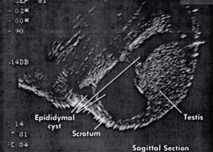 Epidydimal cyst (1981)