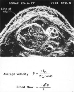 First umbilical vein flow measurement (1977)