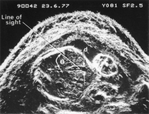 First umbilical vein flow measurement (1977)
