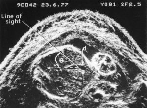 First umbilical vein flow measurement (1977)