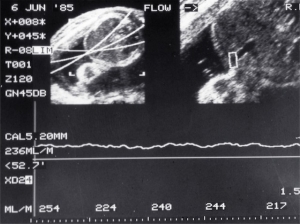 Umbilical flow measurement (1985)