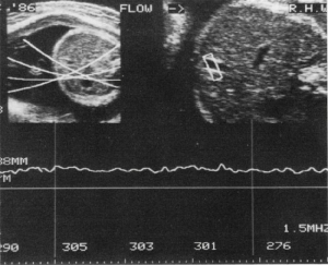 Umbilical flow measurement (1986)