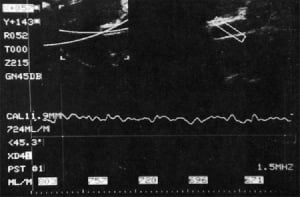 Portal vein flow in fasting/feeding study