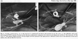 Adjustable portacaval shunt device