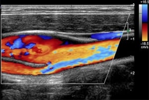 Second generation colour Doppler developed by UI