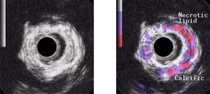 Intravascular tissue characterisation