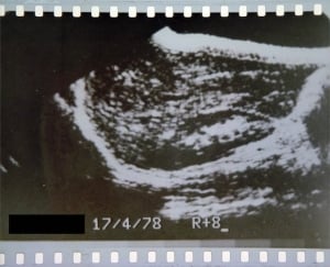 Paediatric liver and kidney (1978, courtesy Roger Gent)