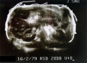 Compound transverse abdominal scan (1979, courtesy Roger Gent)